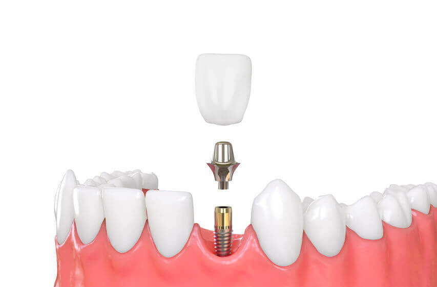 ds-implants