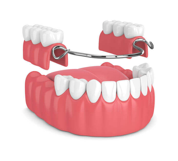ds-partial-dentures