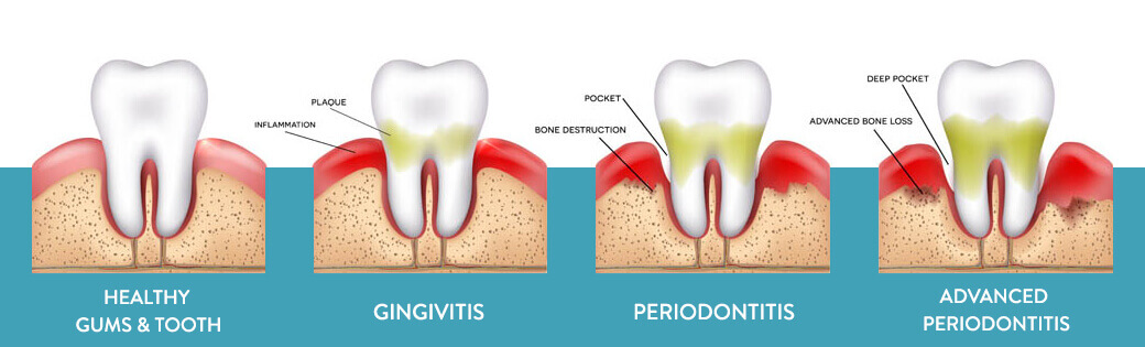 ds-periodontal-therapy
