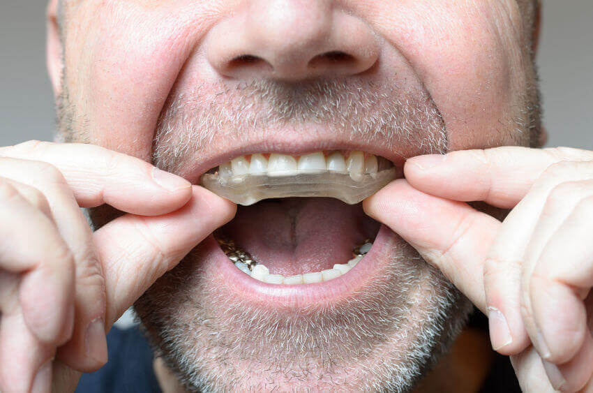 ds-tmd-bruxism-night-guards
