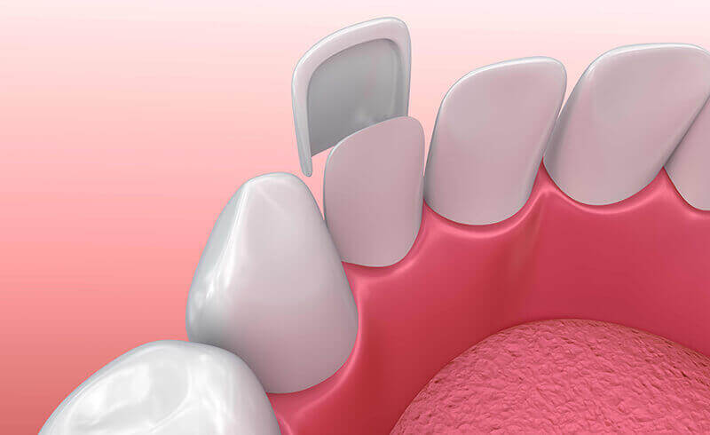 ds-veneers